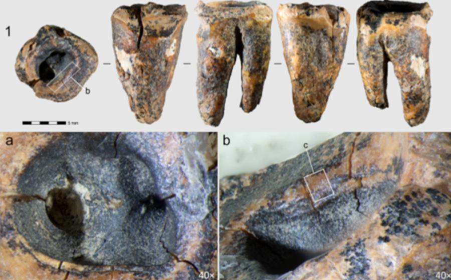Chagyrskaya 64 molar tooth showing the drilled cavity evidence of Neanderthal Dentistry