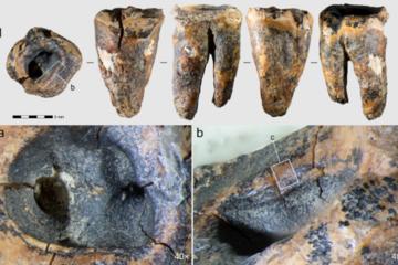 Chagyrskaya 64 molar tooth showing the drilled cavity evidence of Neanderthal Dentistry