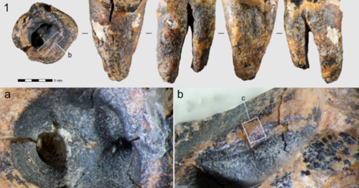 Chagyrskaya 64 molar tooth showing the drilled cavity evidence of Neanderthal Dentistry